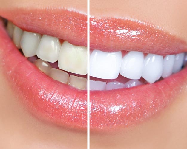 Dentures
