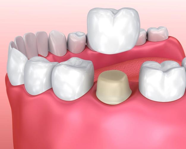 dental crowns and caps in Bangalore