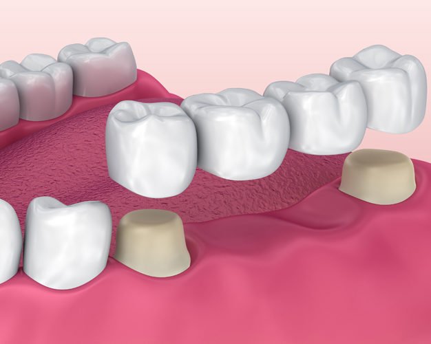 Best Dentist in Bangalore for Dental Bridge