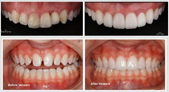 Dental Veneers