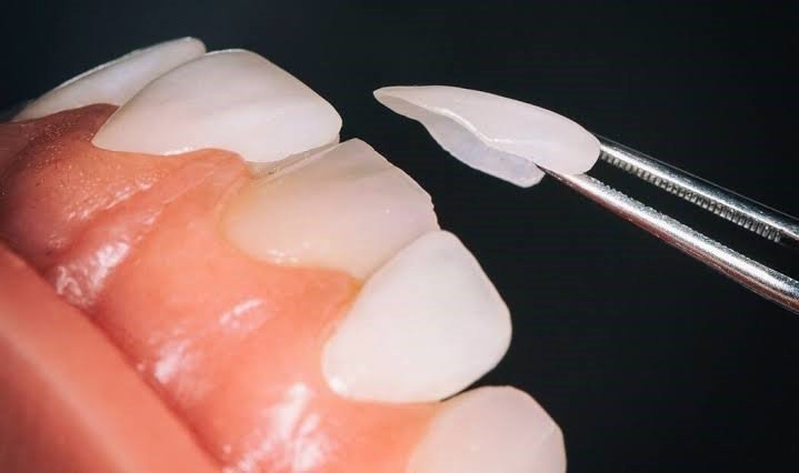 Dental Veneers