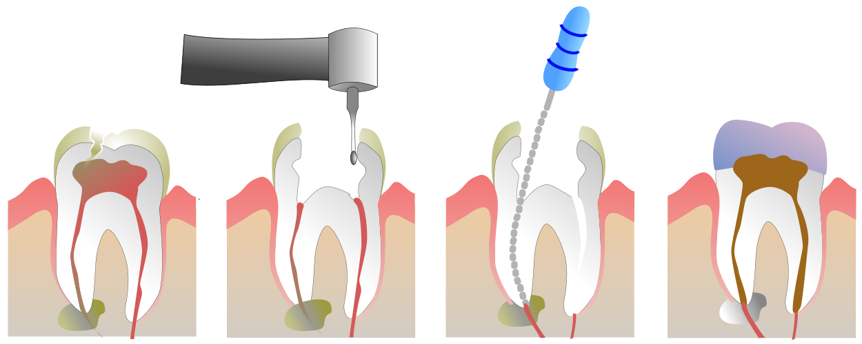 Root Canal Treatment
