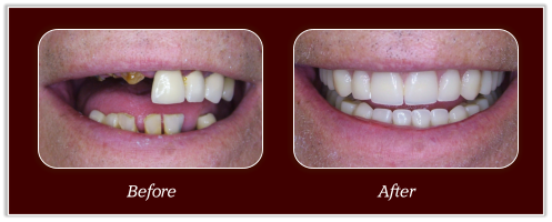 dentures comparison