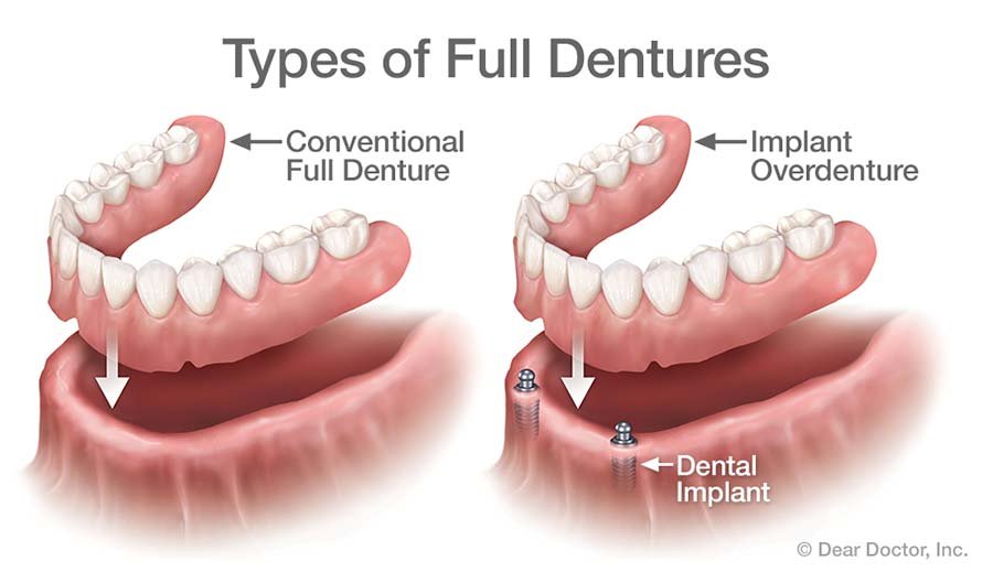 types-of-full-dentures
