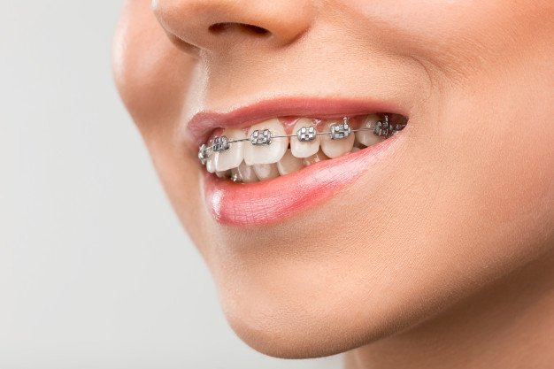best dentist in Bangalore for braces